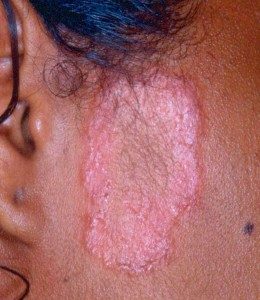 Hanseníase (lepra): o que é, sintomas e tratamento